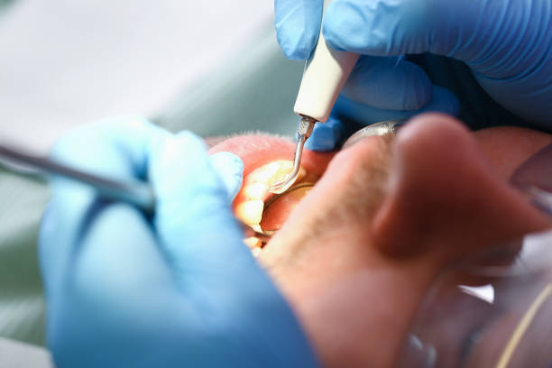 Best Emergency Dental Care for Broken or Chipped Teeth in Reynoldsburg, OH